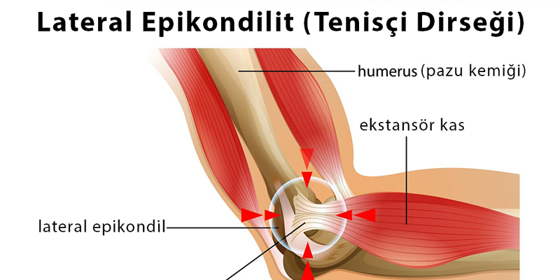 Lateral Epikondilit – Tenisçi Dirseği 800X200 bannerR