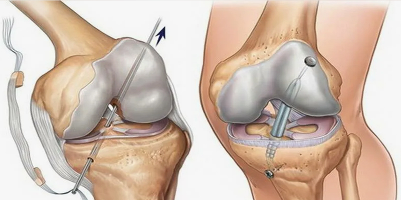 ön çapraz bağ öçb ameliyatı 800X400 bannerR